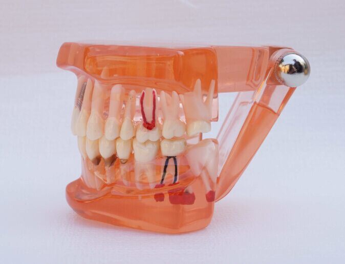 Dental Implanting Restoration Model/Implant Restoration Model/Dental Teeth Model