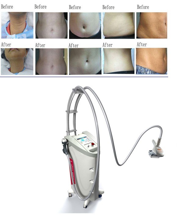 Body Shaping Slimming Machine Fat Reduction RF Velashape Beauty Equipment