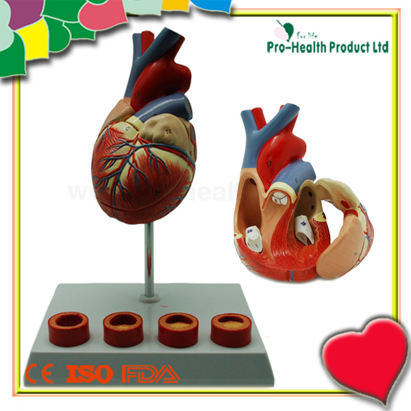 Atherosclerosis Plastic Human Heart Model