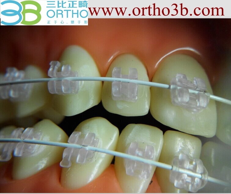 Orthodontic Roth Ceramic Brackets with Best Quality