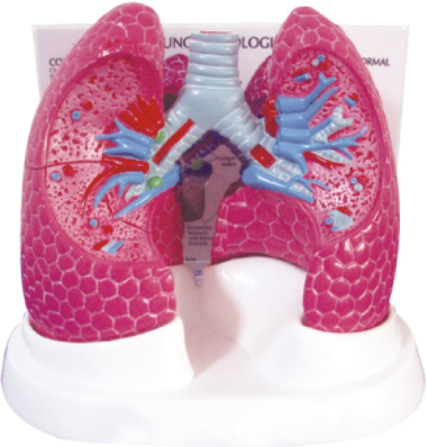 Lung Model with Bronchopulmonary Pathology-Mh07029
