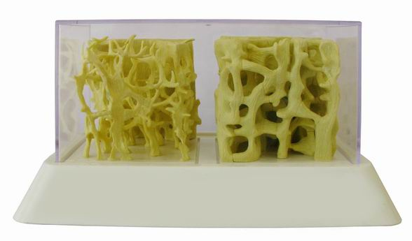  AB112 Bone Density Model
