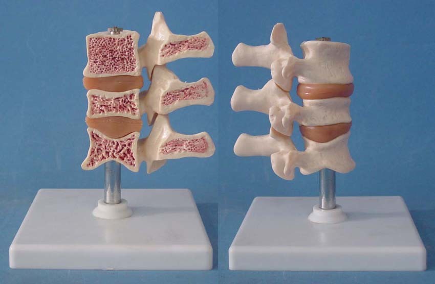 Cutaway Osteoporosis Gd0153D005