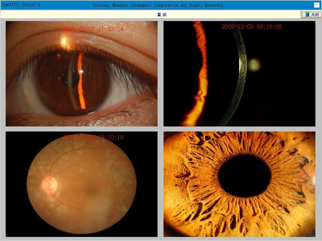 Digital Imaging System for Fundus Camera, Slit Lamp and Operating Microscope