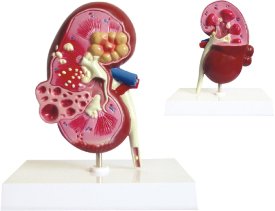 Dissection Model of Kidney with Cyst-Mh07037