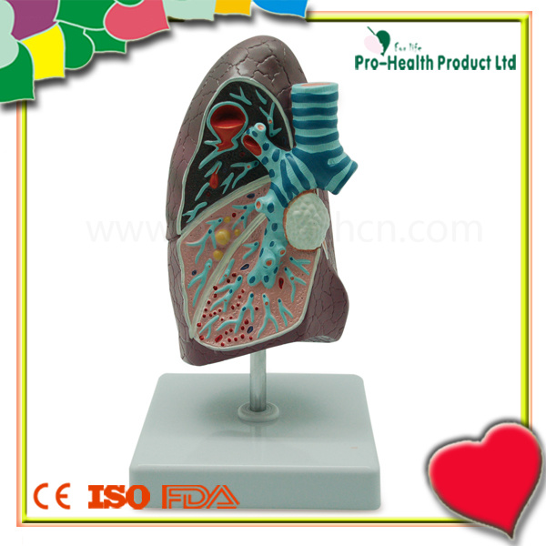 Educational Demonstration Disease Lung Anatomical Model
