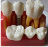 Dental Implants Communication Teeth Model/Implant Display Teeth Model