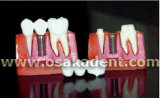 Dental Teaching Model of Implant Model (OSA-393)