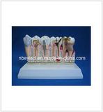 Model of Common Disease of Teeth (EYAM-13) 