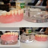 Dental 2 Implants Locator Lower Arch Model