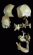 Separated Skull (Plastinated Specimen)