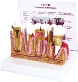 Model of Dental Pulp Diease-Mh06005