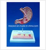 Dissection Model of Diseased Stomach (EYAM-15) 