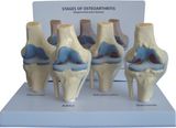 Pathological Model of Knee Joint with Card-Mh01017