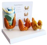 Model of Thyroid Disease-Mh06022