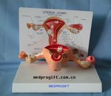 Diseased Uterus Model