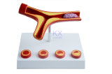 Hot Sale Arteriosclerosis Model with Thrombus