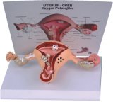 Pathological Uterine Model