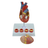 2 Parts Luxury Heart Model with 4 Stage Vessel