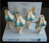 Se34072 Four Stages of Osteoarthritis Anatomical Model