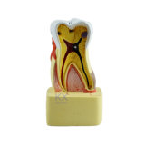 Hot Sale Teeth Tooth Decay Model