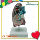 Educational Demonstration Disease Lung Anatomical Model